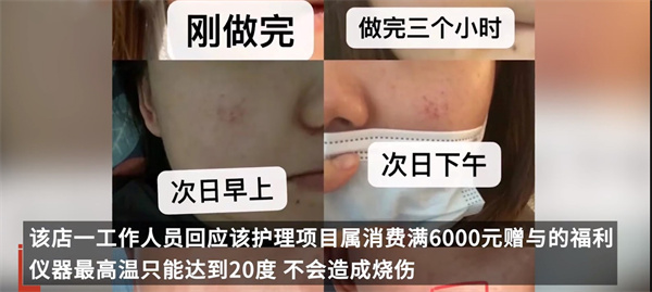 陕西一网友称在赫莲娜店做过护理后脸部烧伤