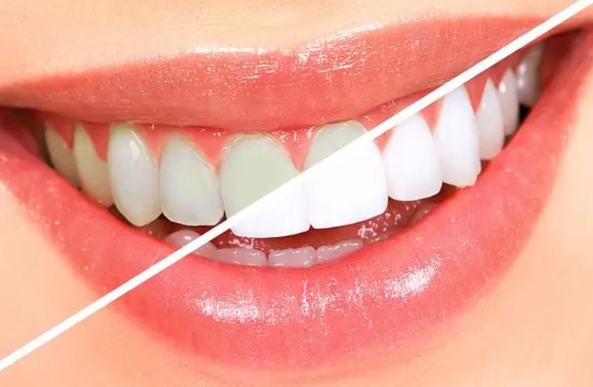 美牙贴真能使牙齿变白吗?真相是这样的